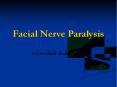 Facial Nerve Paralysis PowerPoint PPT Presentation