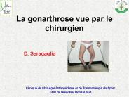 La gonarthrose vue par le chirurgien