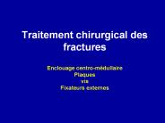 Traitement chirurgical des fractures Enclouage centro-m