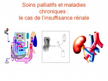 Soins palliatifs et maladies chroniques : le cas de l