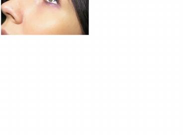 Zakazenie miejsca operowanego