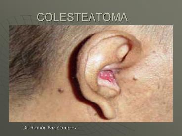COLESTEATOMA