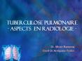 TUBERCULOSE PULMONAIRE - ASPECTS EN RADIOLOGIE - PowerPoint PPT Presentation