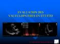 EVALUATION DES VALVULOPATHIES EN ETT/ETO PowerPoint PPT Presentation