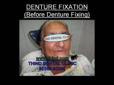Denture Fixation