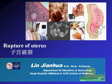 Rupture of uterus   ????