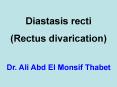 Diastasis recti PowerPoint PPT Presentation