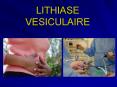 LITHIASE VESICULAIRE PowerPoint PPT Presentation