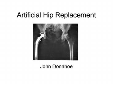Artificial Hip Replacement