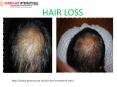 Homeopathic treatment for hair loss PowerPoint PPT Presentation