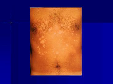 Papulosquamous  Eruptions