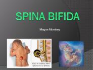 Spina Bifida