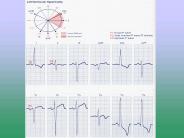 Miscellaneous EKG Changes Chapter 14
