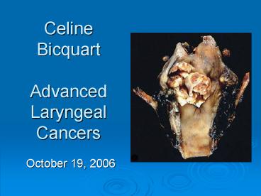 Celine Bicquart Advanced Laryngeal Cancers