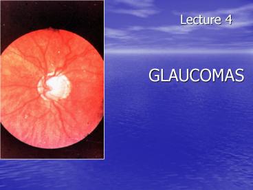 Lecture 4              GLAUCOMAS