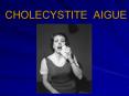 CHOLECYSTITE AIGUE PowerPoint PPT Presentation