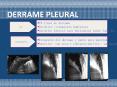 DERRAME PLEURAL PowerPoint PPT Presentation