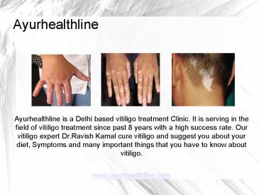 Ayurvedic Anti Vitiligo Treatment in India