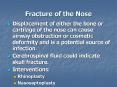 Fracture of the Nose PowerPoint PPT Presentation