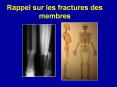 Rappel sur les fractures des membres PowerPoint PPT Presentation