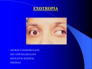 EXOTROPIA