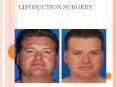 liposuction Bangalore PowerPoint PPT Presentation