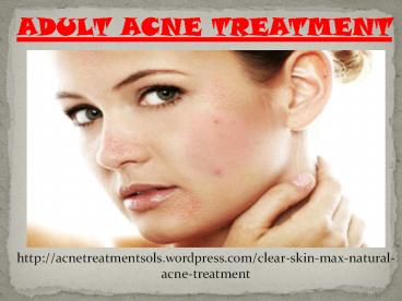 Natural Remedies for Adult Acne