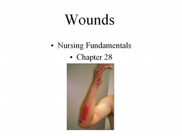 Wounds