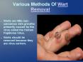 Various Methods Of Wart Removal PowerPoint PPT Presentation