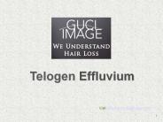 Telogen Effluvium