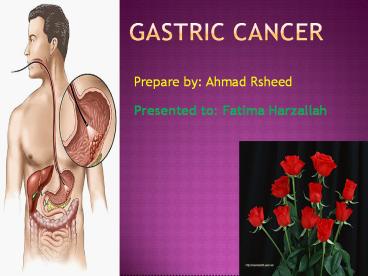 Gastric Cancer