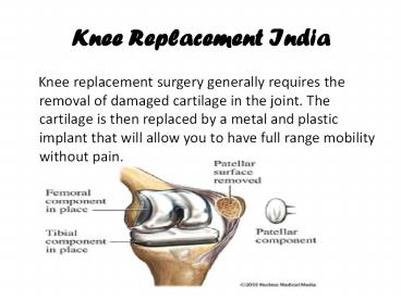 PPT – Knee Replacement India PowerPoint presentation | free to download ...