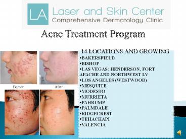 Taheri Acne Powerpoint