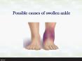 Possible causes of swollen ankle PowerPoint PPT Presentation
