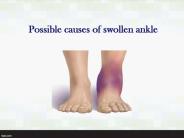 Possible causes of swollen ankle