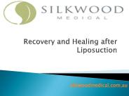 Recovery and Healing after Liposuction
