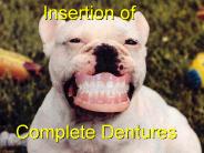 Complete Dentures