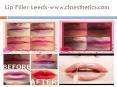 Lip Filler Leeds-www.claesthetics.com PowerPoint PPT Presentation