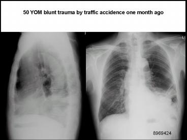 Imaging of Diaphragmatic Injury: A Diagnostic Challenge?