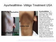 Vitiligo Treatment USA, Leucoderma Cure