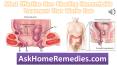 Most  Effective  Non  Bleeding  Hemorrhoids Treatment  That  Works  Fast PowerPoint PPT Presentation