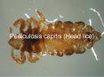 ?? Pediculosis capitis (Head lice) PowerPoint PPT Presentation