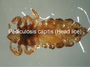 ?? Pediculosis capitis (Head lice)