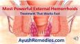 Most Powerful External Hemorrhoids Treatment That Works Fast PowerPoint PPT Presentation