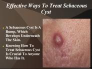 Effective Ways To Treat Sebaceous Cyst
