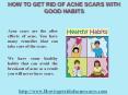 How To Get Rid Of Acne Scars With Good Habits PowerPoint PPT Presentation