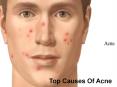 Top Causes Of Acne PowerPoint PPT Presentation