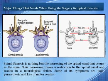 Surgery for Spinal Stenosis