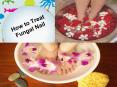 How to Treat Fungal Nail PowerPoint PPT Presentation