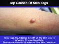 Top Causes Of Skin Tags PowerPoint PPT Presentation